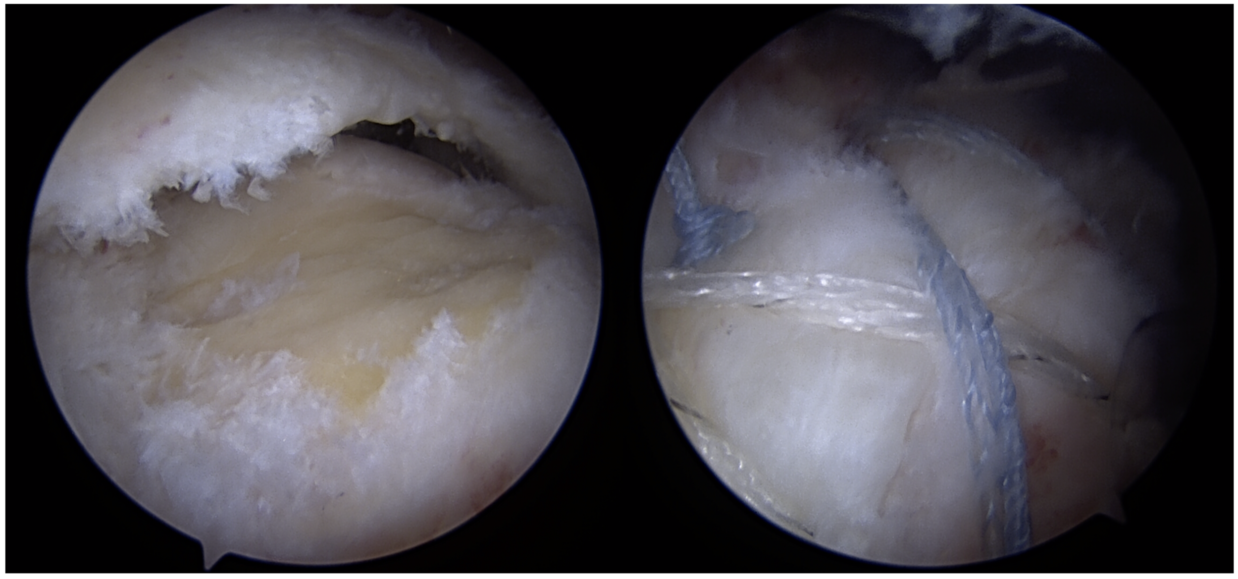 Rotator cuff online injury surgery